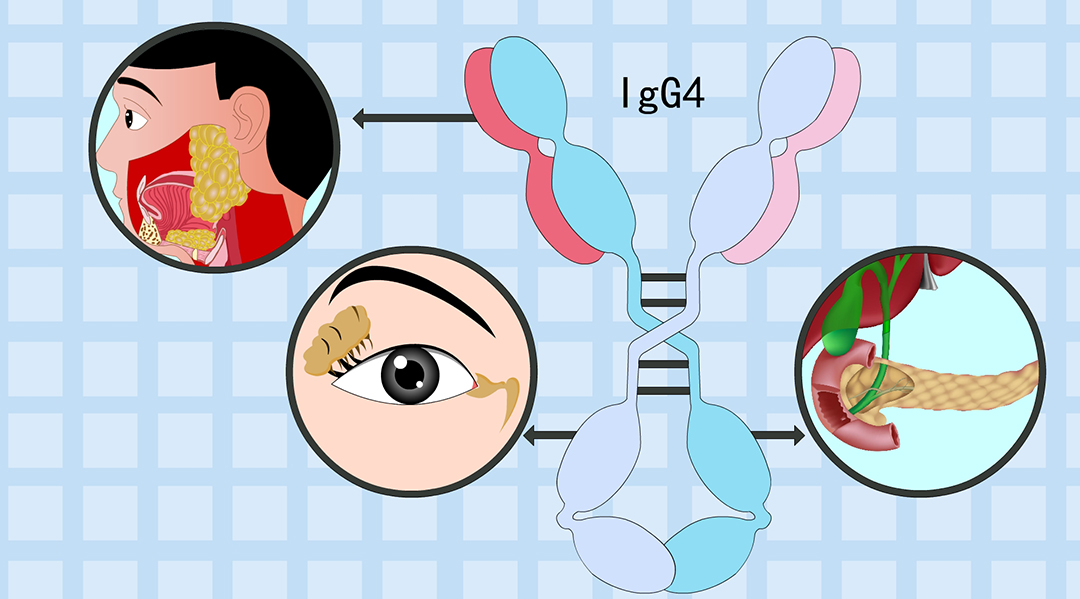 一文带你了解IgG4这个指标